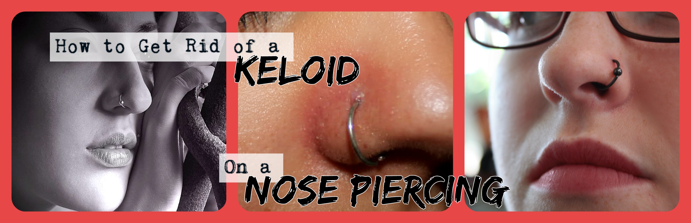 How to get Rid of a Keloid on a Nose Piercing