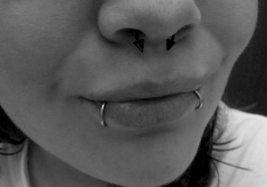 Snakebites and septum